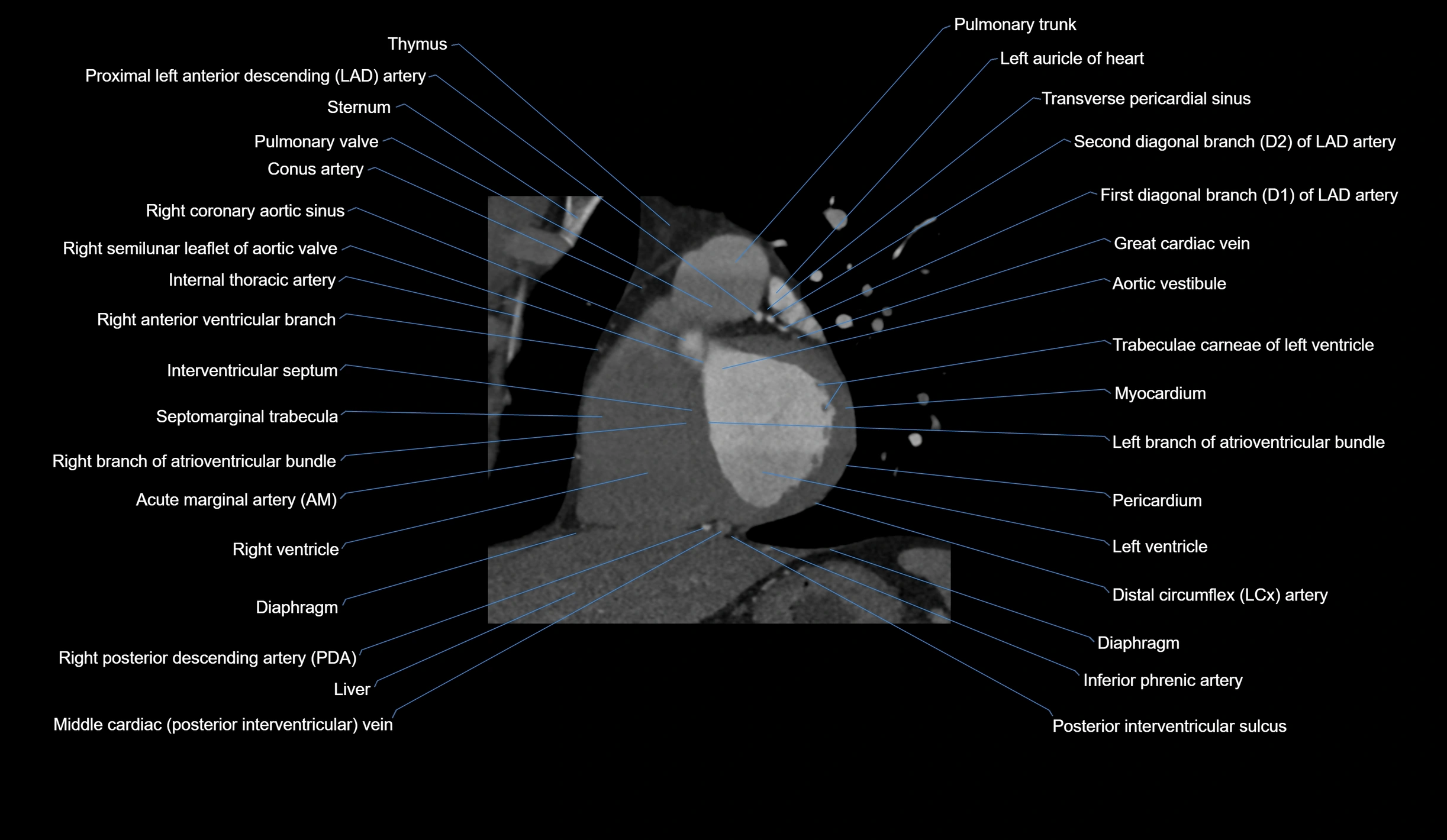 CT heart (coronary angiogram) short axis view  cross sectional anatomy labelled radiology image-00026.webp